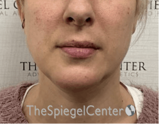 Chin Augmentation Before & After Gallery - Patient 246702 - Image 2