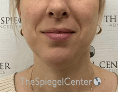 Chin Augmentation Before & After Gallery - Patient 246702 - Image 1