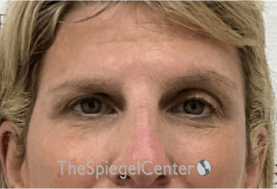 Temple Filler Before & After Gallery - Patient 307185 - Image 2