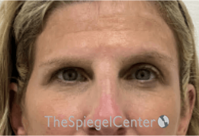 Temple Filler Before & After Gallery - Patient 307185 - Image 1