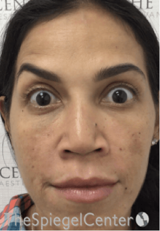 Botox / Dysport / Jeuveau / Xeomin Before & After Gallery - Patient 500677 - Image 4