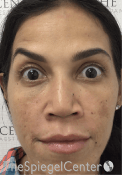 Botox / Dysport / Jeuveau / Xeomin Before & After Gallery - Patient 500677 - Image 4