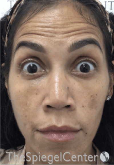 Botox / Dysport / Jeuveau / Xeomin Before & After Gallery - Patient 500677 - Image 3