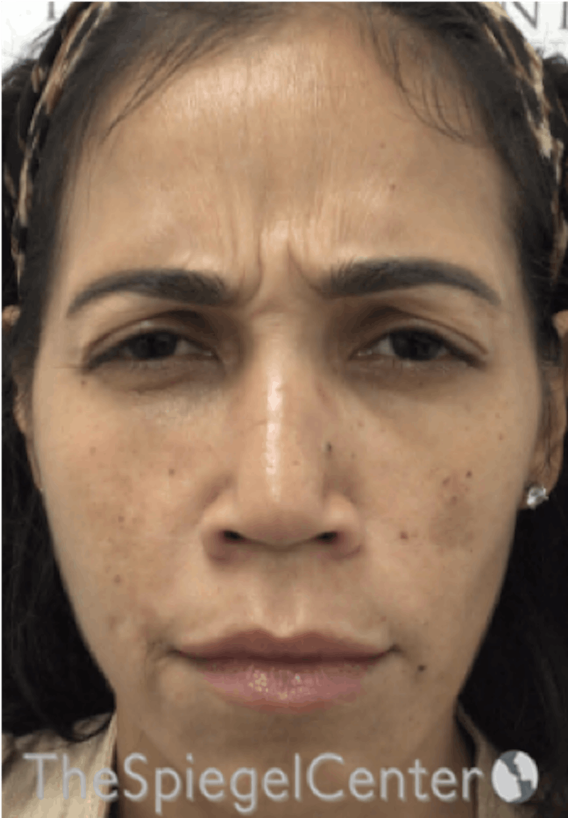 Botox / Dysport / Jeuveau / Xeomin Before & After Gallery - Patient 500677 - Image 1