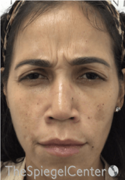 Botox / Dysport / Jeuveau / Xeomin Before & After Gallery - Patient 500677 - Image 1