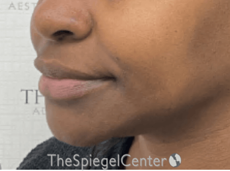 Nasolabial Fold Filler Before & After Gallery - Patient 398925 - Image 4