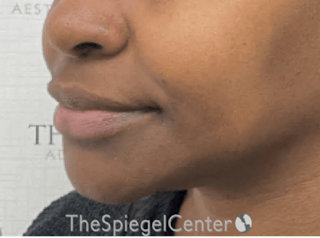 Nasolabial Fold Filler Before & After Gallery - Patient 398925 - Image 4