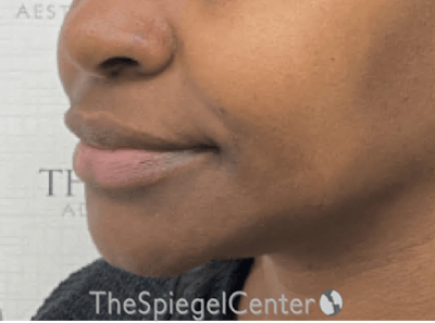 Nasolabial Fold Filler Before & After Gallery - Patient 398925 - Image 4