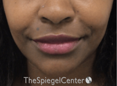 Nasolabial Fold Filler Before & After Gallery - Patient 398925 - Image 2