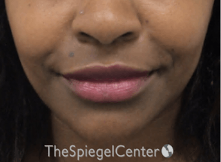 Nasolabial Fold Filler Before & After Gallery - Patient 398925 - Image 2