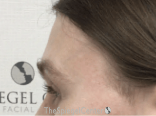 Forehead Contouring Before & After Gallery - Patient 302833 - Image 4