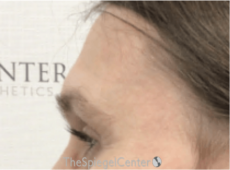 Forehead Contouring Before & After Gallery - Patient 302833 - Image 3