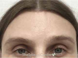 Forehead Contouring Before & After Gallery - Patient 302833 - Image 2
