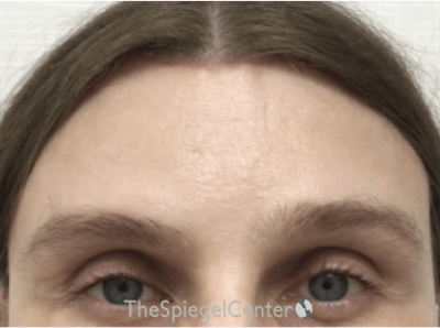 Forehead Contouring Before & After Gallery - Patient 302833 - Image 2