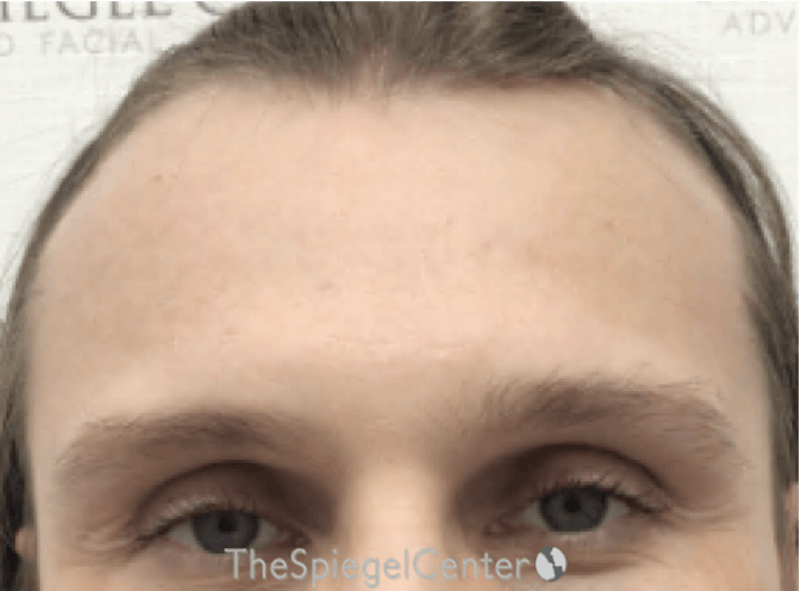 Forehead Contouring Before & After Gallery - Patient 302833 - Image 1