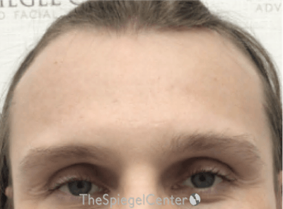 Forehead Contouring Before & After Gallery - Patient 302833 - Image 1