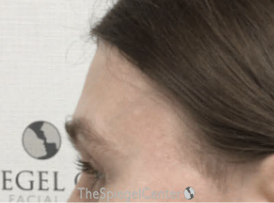 Scalp Advancement Before & After Gallery - Patient 418266 - Image 4