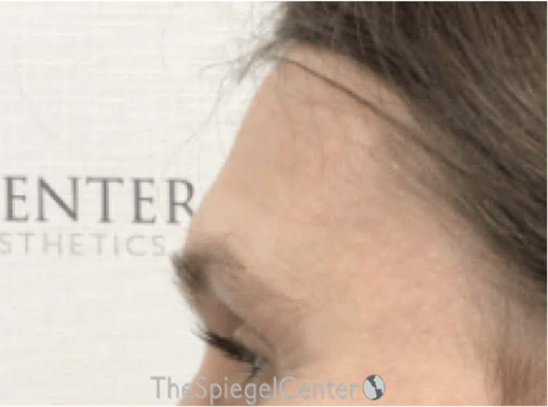 Scalp Advancement Before & After Gallery - Patient 418266 - Image 3