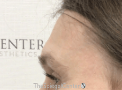 Scalp Advancement Before & After Gallery - Patient 418266 - Image 3