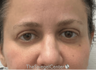 Tear Trough / Under Eye Fillers Before & After Gallery - Patient 242817 - Image 2