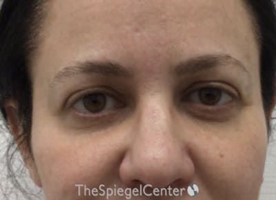 Tear Trough / Under Eye Fillers Before & After Gallery - Patient 242817 - Image 1