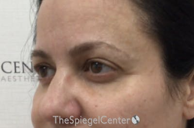 Tear Trough / Under Eye Fillers Before & After Gallery - Patient 242817 - Image 3