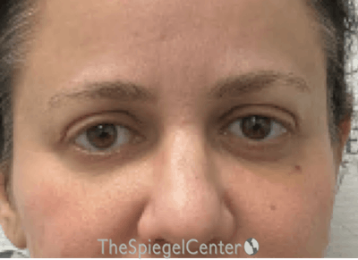 Temple Filler Before & After Gallery - Patient 169356 - Image 2