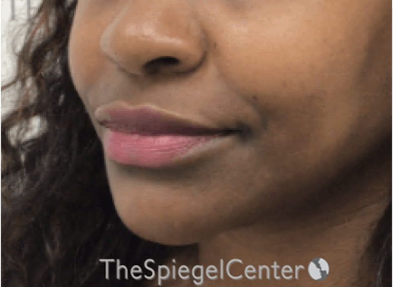 Lip Filler Before & After Gallery - Patient 199455 - Image 6