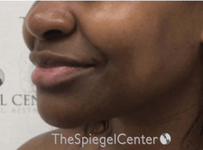Lip Filler Before & After Gallery - Patient 199455 - Image 5