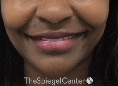 Lip Filler Before & After Gallery - Patient 199455 - Image 4