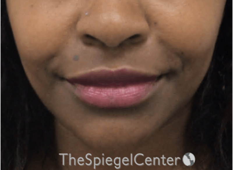 Lip Filler Before & After Gallery - Patient 199455 - Image 2