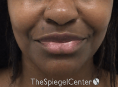 Lip Filler Before & After Gallery - Patient 199455 - Image 1