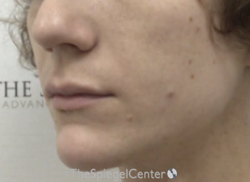 Lip Filler Before & After Gallery - Patient 110195 - Image 6
