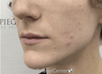 Lip Filler Before & After Gallery - Patient 110195 - Image 5