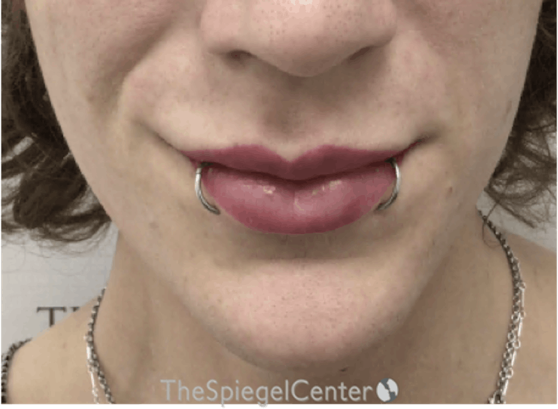 Lip Filler Before & After Gallery - Patient 110195 - Image 4