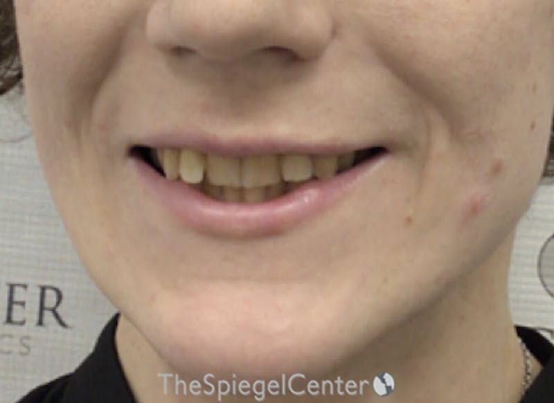 Lip Filler Before & After Gallery - Patient 110195 - Image 3