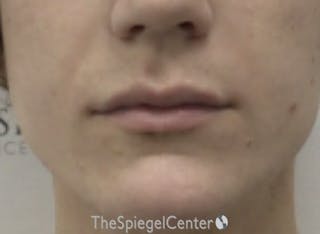 Lip Filler Before & After Gallery - Patient 110195 - Image 2