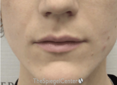 Lip Filler Before & After Gallery - Patient 110195 - Image 1