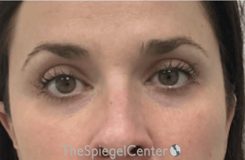 Temple Filler Before & After Gallery - Patient 134989 - Image 1