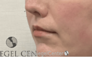 Lip Lift Before & After Gallery - Patient 103409 - Image 4