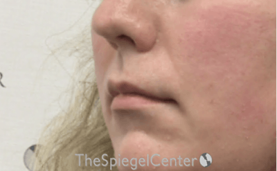 Lip Lift Before & After Gallery - Patient 103409 - Image 3