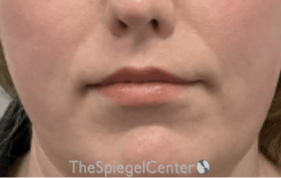Lip Lift Before & After Gallery - Patient 103409 - Image 2