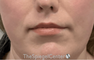 Lip Lift Before & After Gallery - Patient 103409 - Image 2