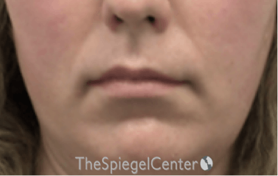 Lip Lift Before & After Gallery - Patient 103409 - Image 1