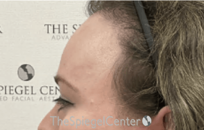 Scalp Advancement Before & After Gallery - Patient 375685 - Image 4