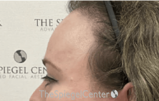 Forehead Contouring Before & After Gallery - Patient 200501 - Image 4