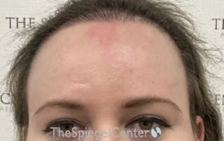 Forehead Contouring Before & After Gallery - Patient 200501 - Image 2