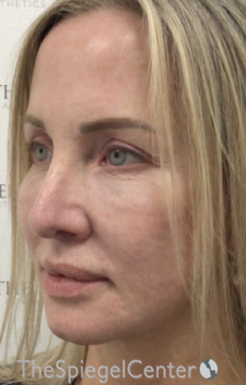 Facelift Before & After Gallery - Patient 679396 - Image 4