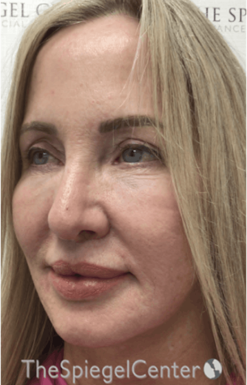 Facelift Before & After Gallery - Patient 679396 - Image 3