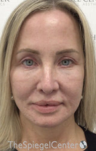 Facelift Before & After Gallery - Patient 679396 - Image 2